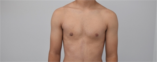Male breast reduction After