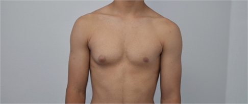 Male breast reduction Before