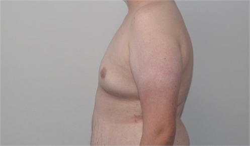 gynecomastia After