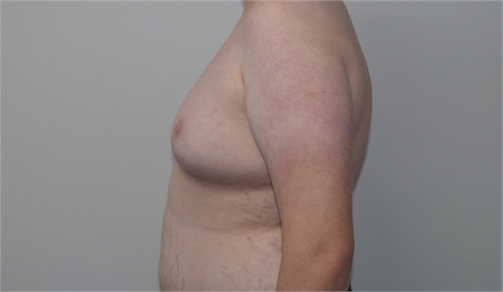 gynecomastia Before