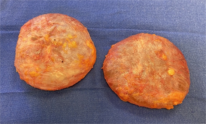 En bloc and total capsulectomy and breast implant removal LA