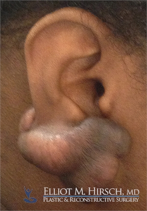 Keloid Surgery Before