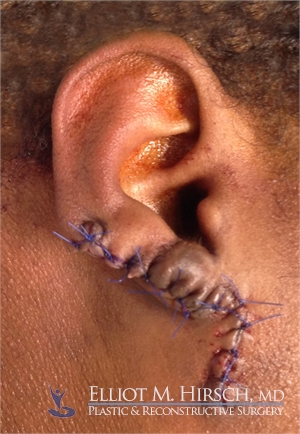 Keloid Surgery After