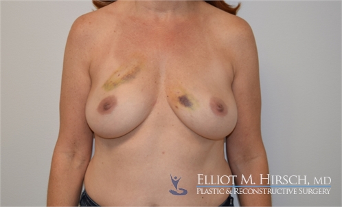 Two Stage Breast Reconstruction Before