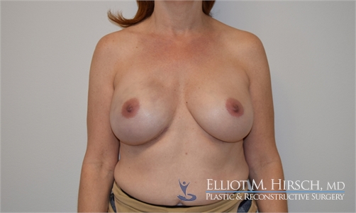 Two Stage Breast Reconstruction After