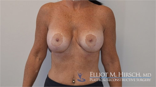 Breast Implant Revision After