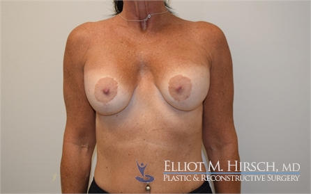 Breast Implant Revision Before