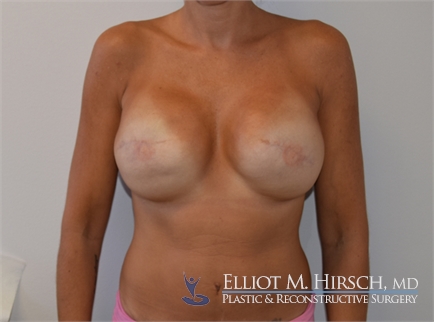 Breast Reconstruction Revision Before