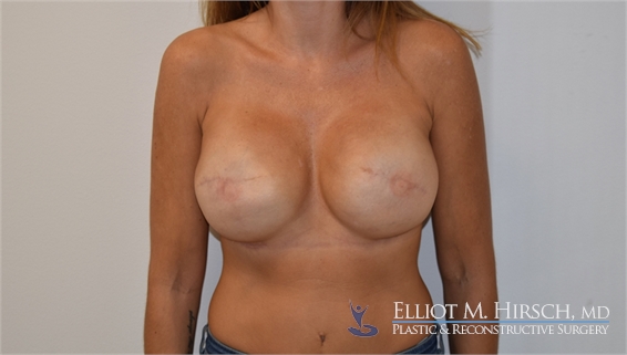 Breast Reconstruction Revision After