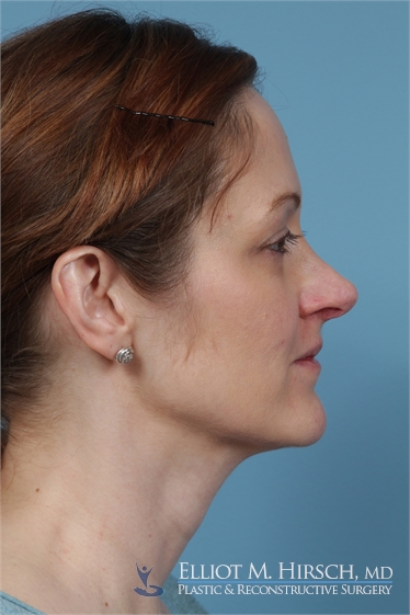 Rhinoplasty Before