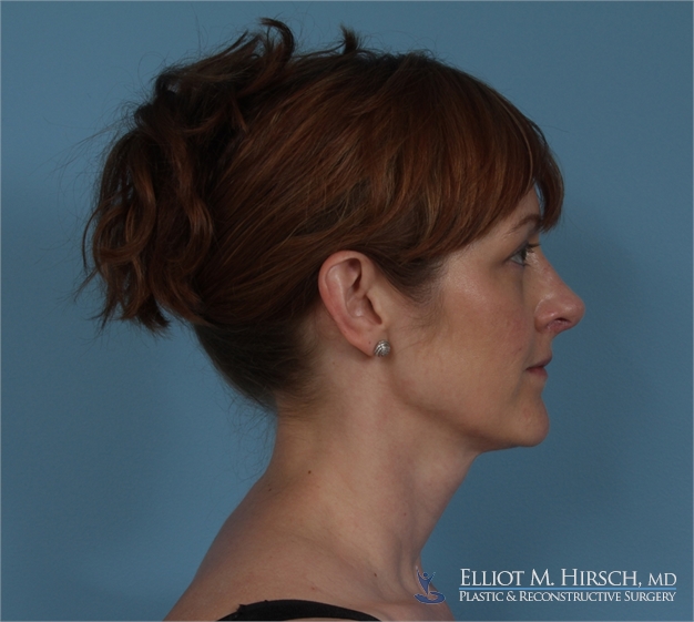 Rhinoplasty After