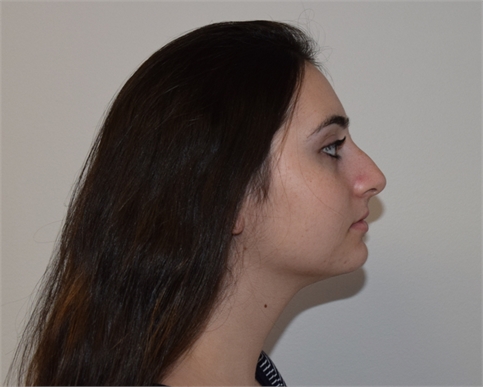 Rhinoplasty Before