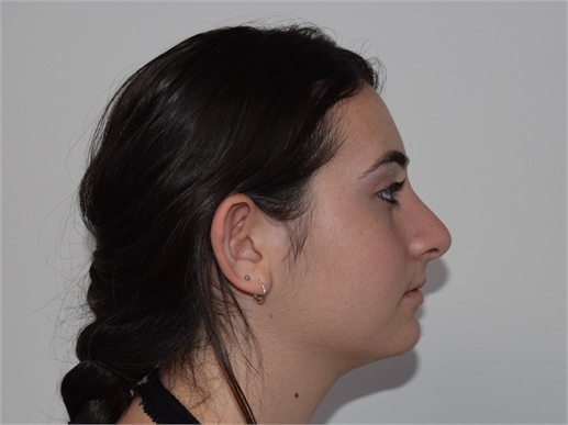 Rhinoplasty After