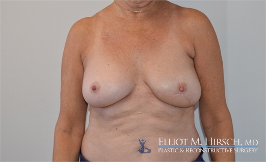 Breast Reconstruction Revision After