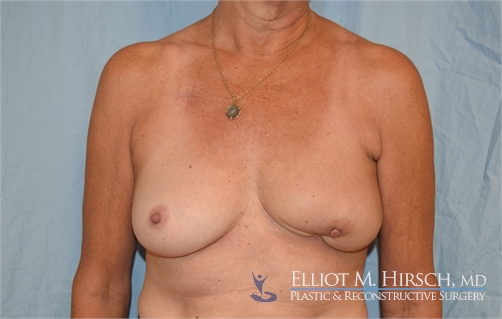 Breast Reconstruction Revision Before