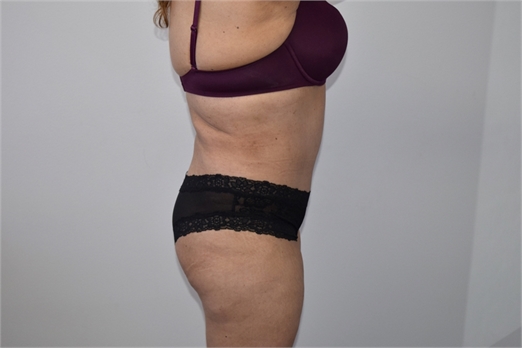 tummy tuck After