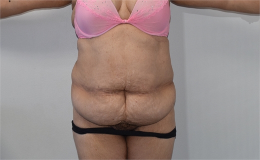 tummy tuck Before