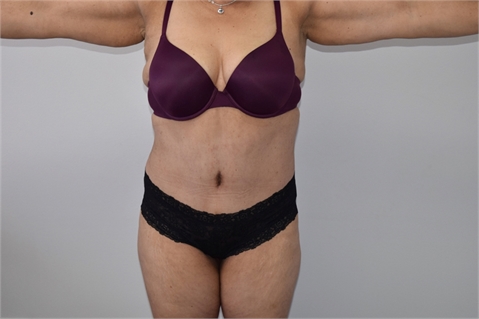 tummy tuck After