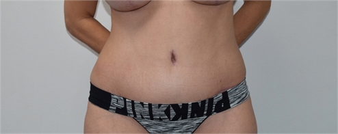 abdominoplasty After