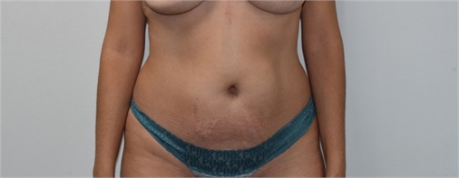 abdominoplasty Before