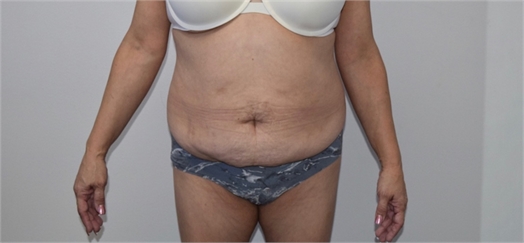 abdominoplasty Before