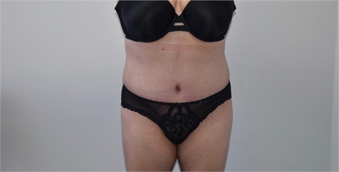 abdominoplasty After