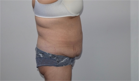 abdominoplasty Before