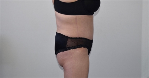 abdominoplasty After