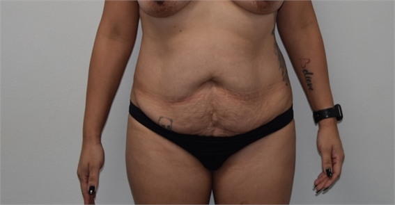 los angeles tummy tuck  Before