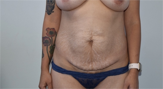 los angeles tummy tuck Before