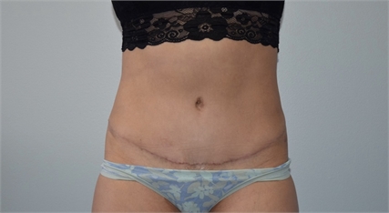 tummy tuck After