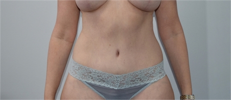 tummy tuck abdominoplasty After