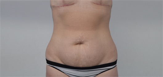 tummy tuck abdominoplasty Before