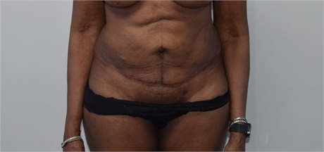 Abdominoplasty Before and After picture Los Angeles Before
