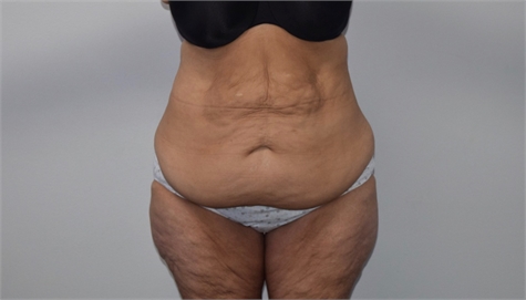 abdominoplasty Before