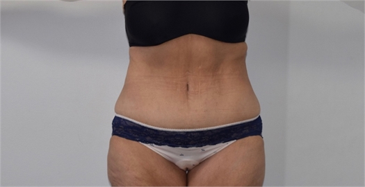 abdominoplasty After