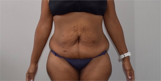 tummy tuck Before