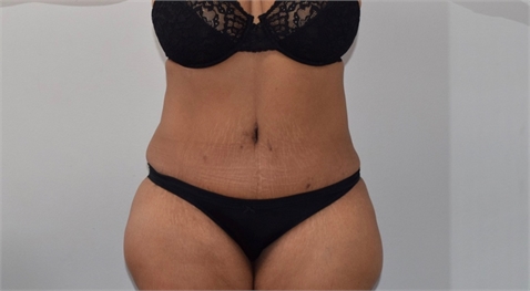 tummy tuck After