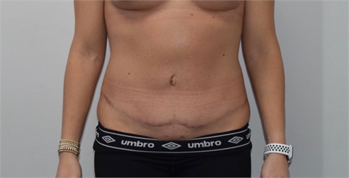 tummy tuck After