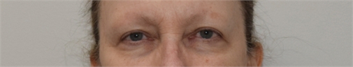 blepharoplasty After