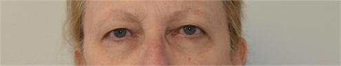 blepharoplasty Before