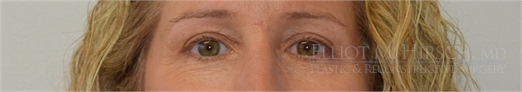 Blepharoplasty After