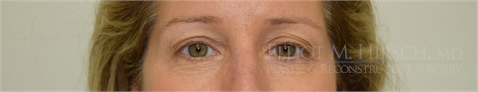 Blepharoplasty Before