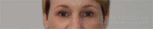 Eyelid Surgery After