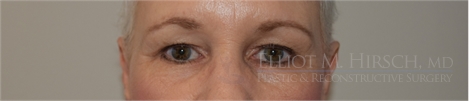 Eyelid Surgery Before