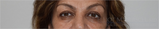 Blepharoplasty After