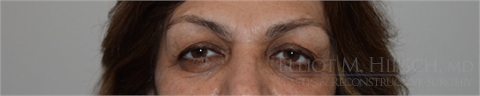 Blepharoplasty Before