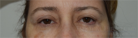 Blepharoplasty Before