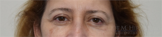 Blepharoplasty After