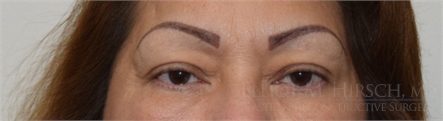 Blepharoplasty Before